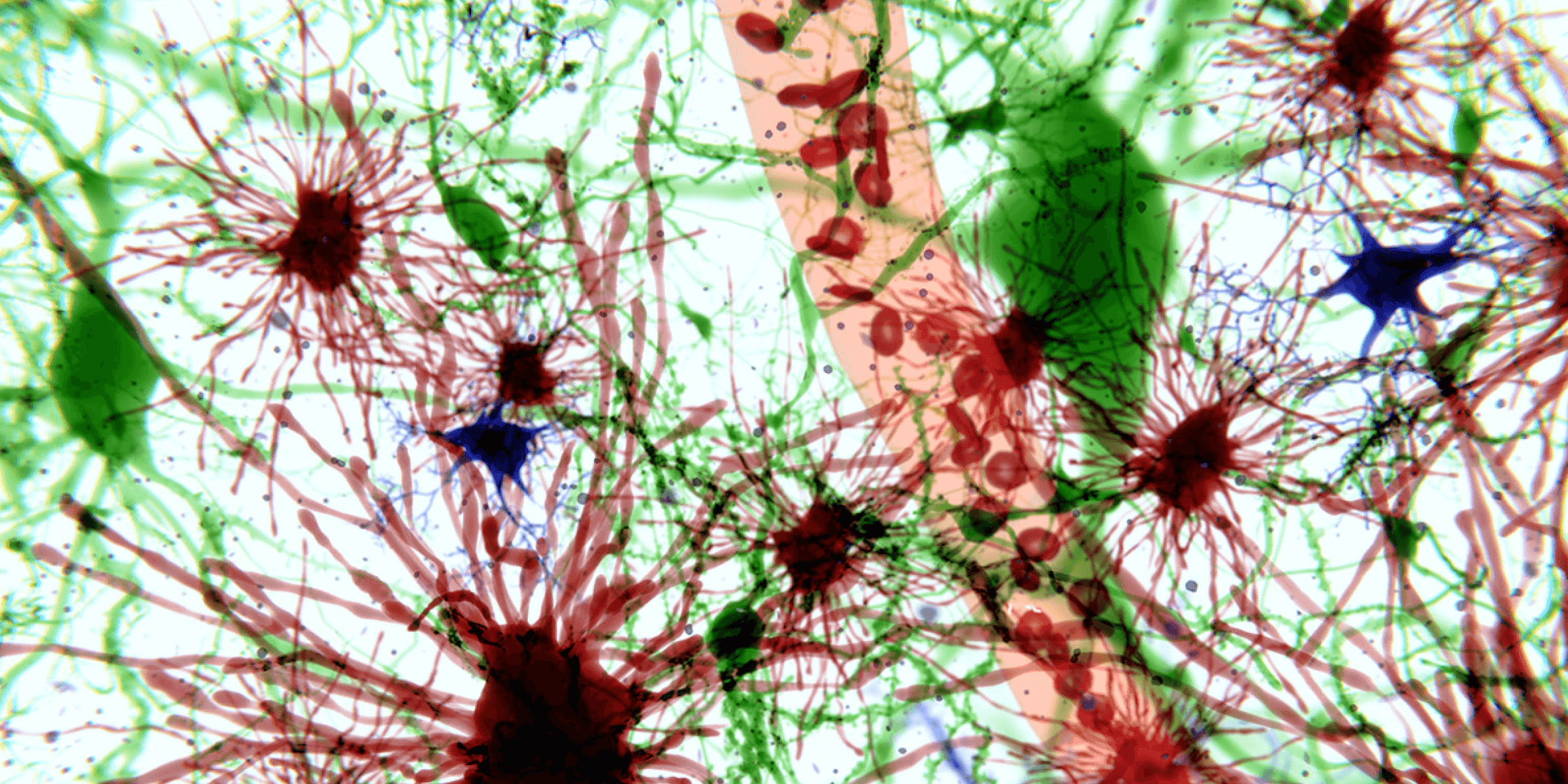 lzheimer en una gota.png